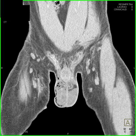 crushed testes|Testicular rupture .